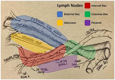 The Role of Lymph Node Dissection in the Treatment of Bladder Cancer